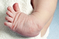 Definition and Causes of Clubfoot