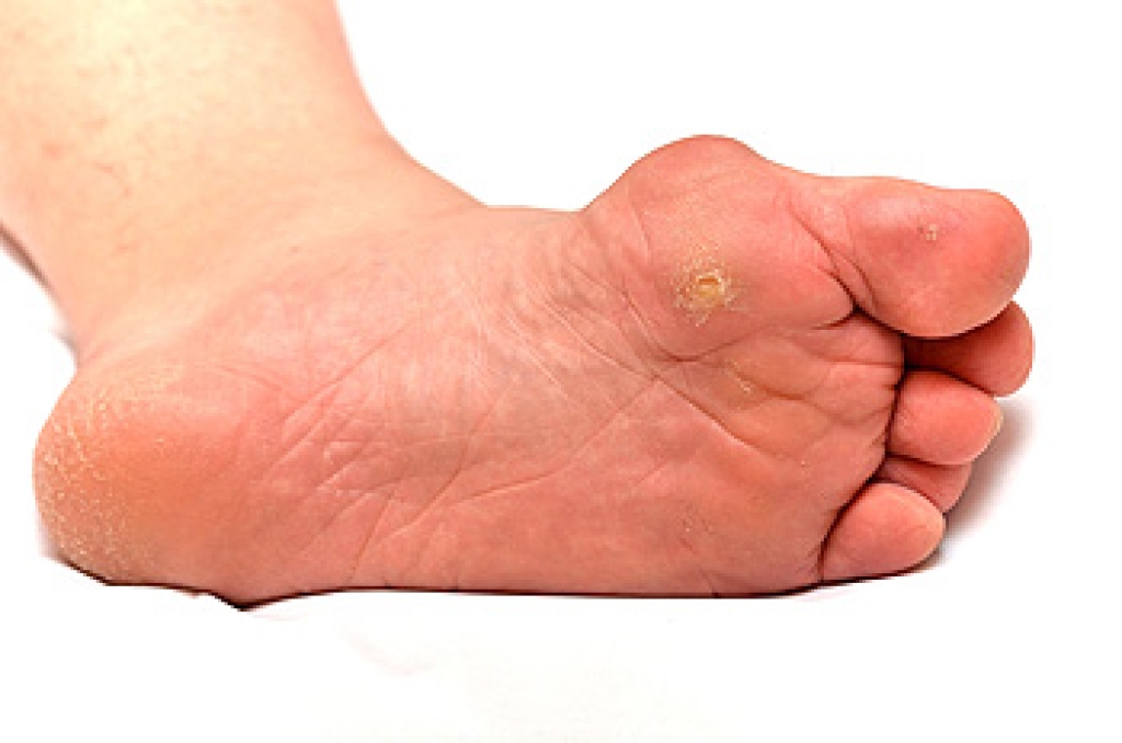 Differences Between Corns and Calluses