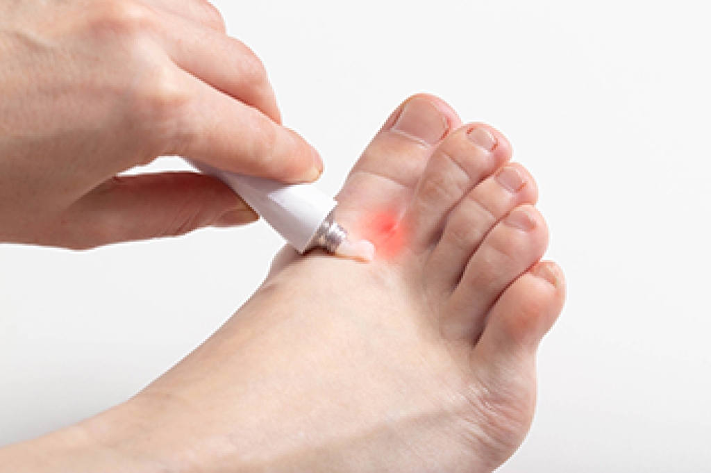 Without Prompt Treatment Athlete’s Foot Can Spread