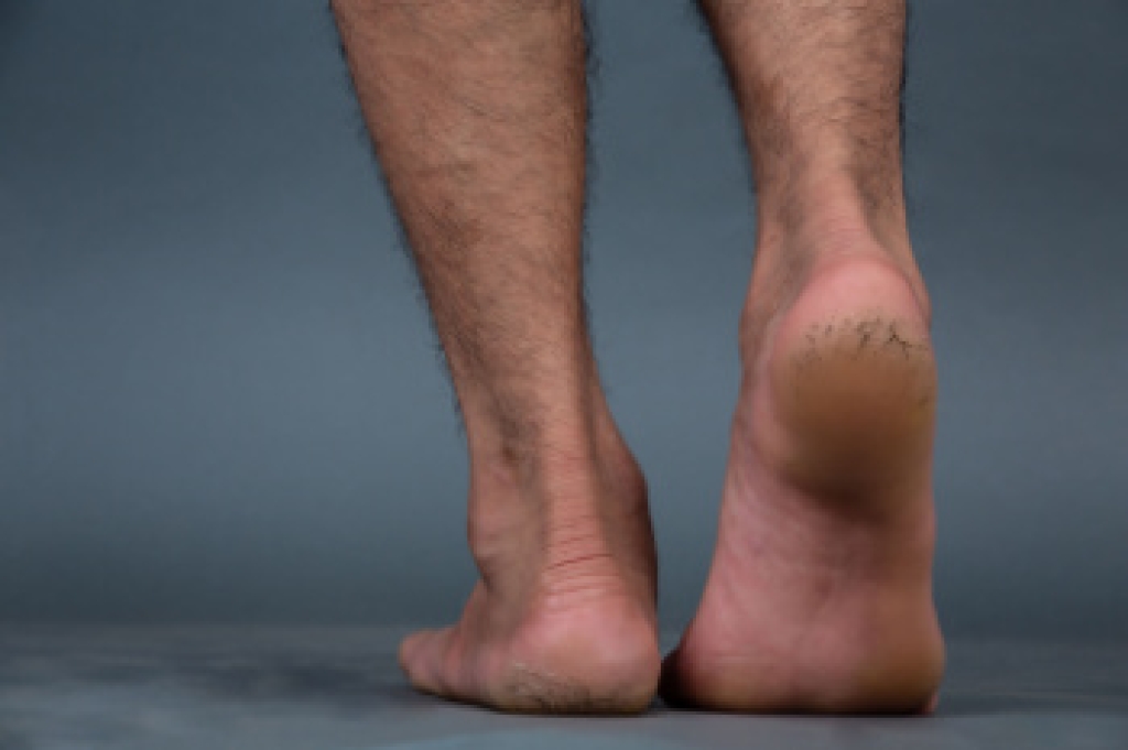 Facts About Cracked Heels