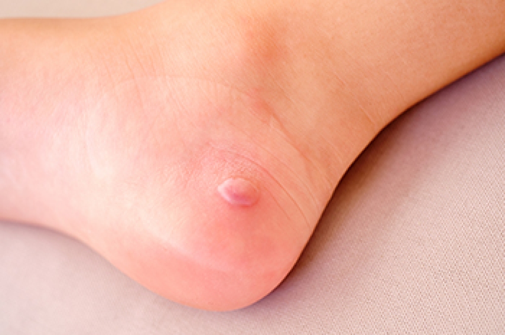 When Foot Blisters Need Professional Care