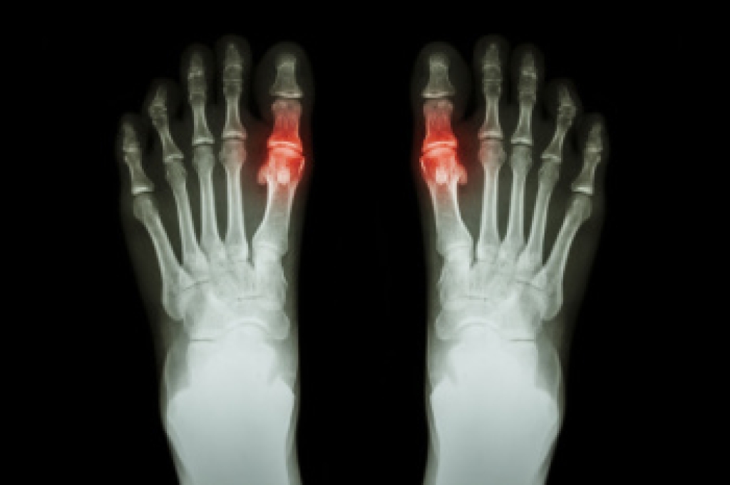 Understanding Chronic Tophaceous Gout