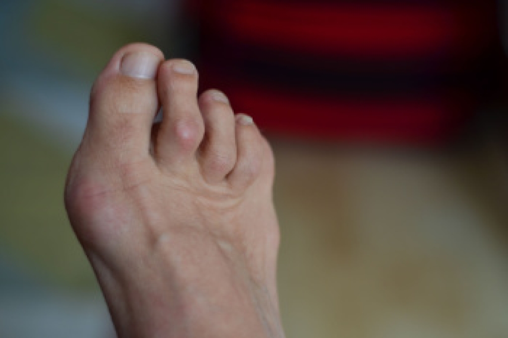 Dealing With Toes That Curl