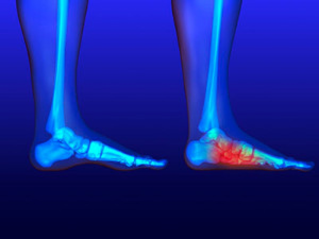 Flat Feet and Their Impact on Foot Health