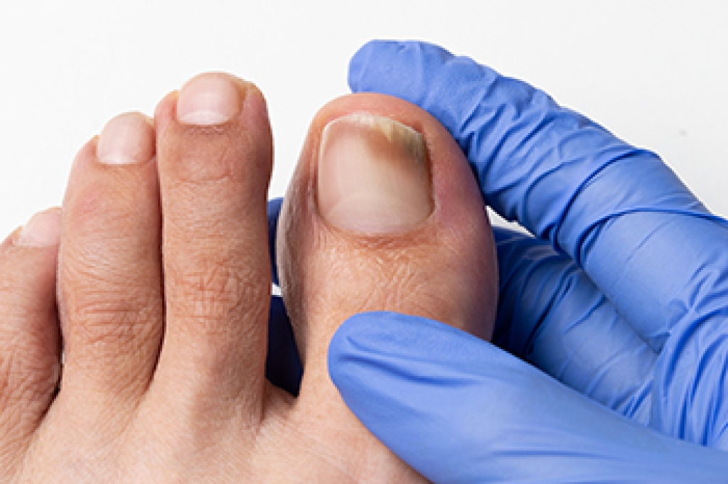 Causes of Toenail Fungal Infections